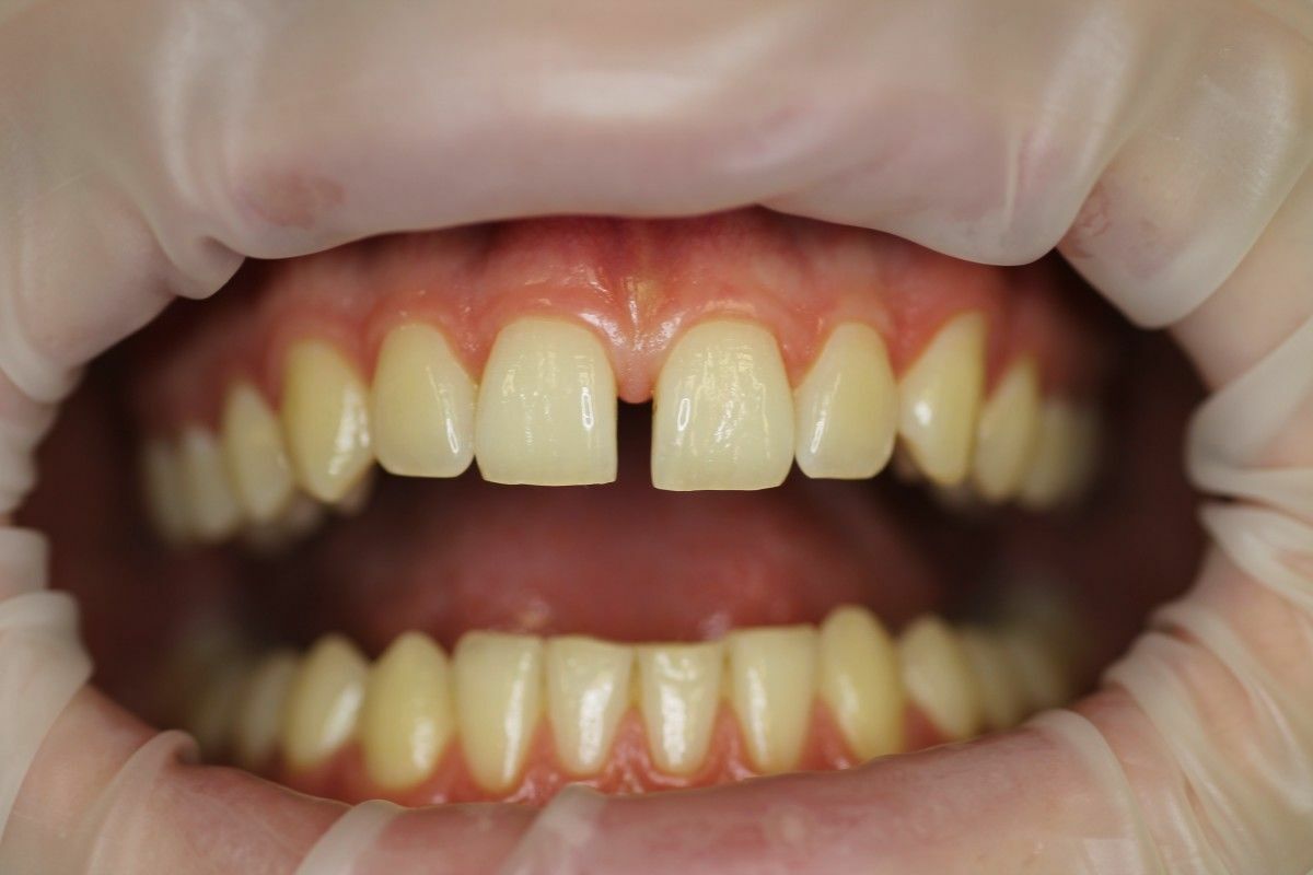 Диастема в стоматологии